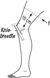 BORT GenuXpress ACL Kniebrace